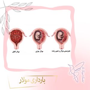بارداری مولار - دکتر فرگل سعادت