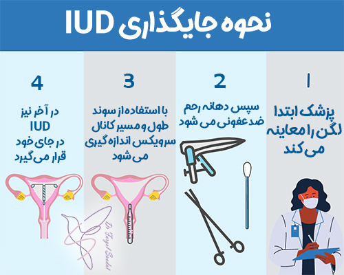 نحوه جایگذاری IUD