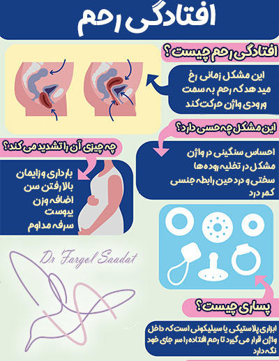 افتادگی رحم
