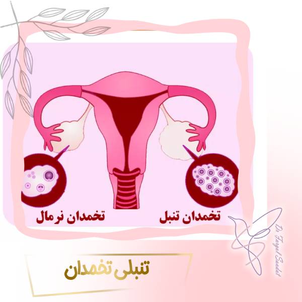 درمان تنبلی تخمدان در تهران