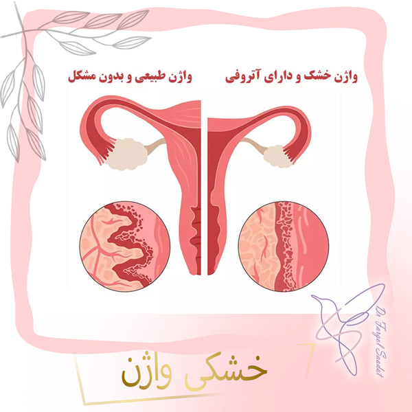 خشکی واژن
https://drfargolsaadat.com/
