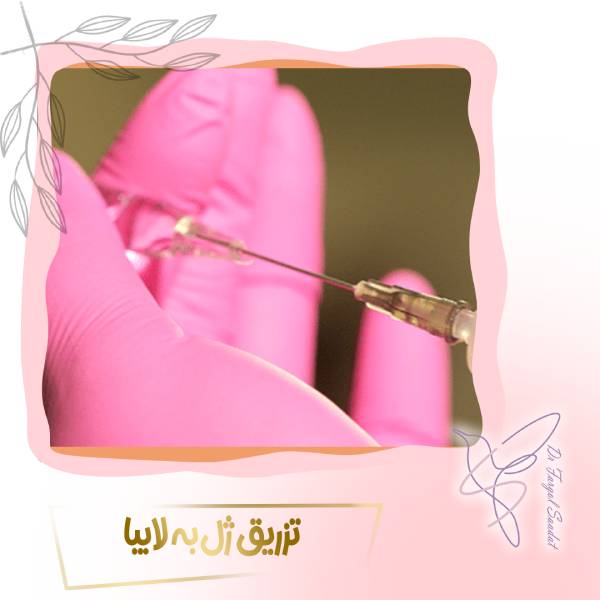 تزریق ژل به لابیا