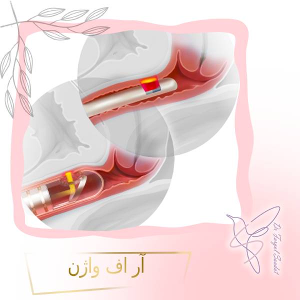 آر اف واژن