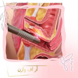 آر اف واژن
