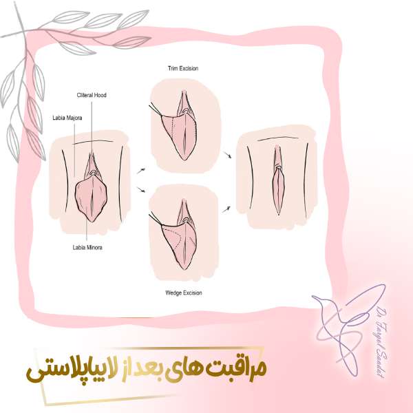 مراقبت های بعد از لابیاپلاستی