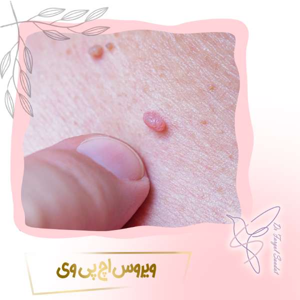 عوارض ویروس اچ پی وی