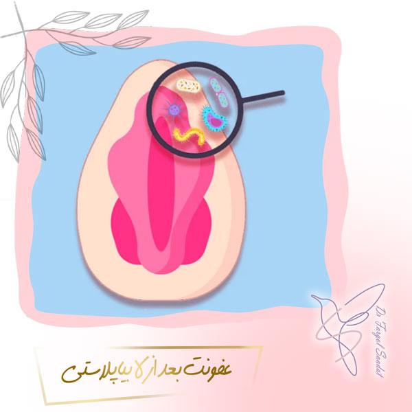 عفونت بعد از لابیاپلاستی