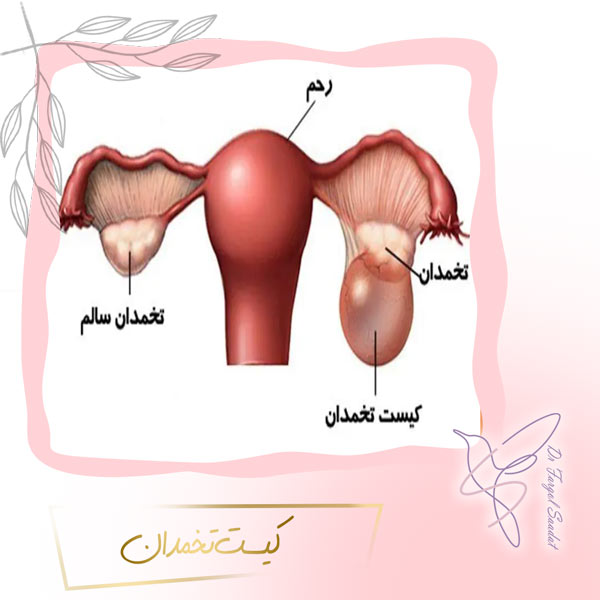کیست تخمدان
