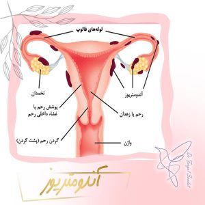 آندومتریوز