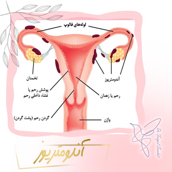 آندومتریوز