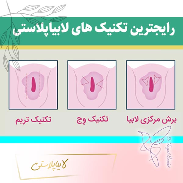Labiaplasty